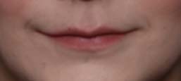 Lip Filler Before & After Patient #31224