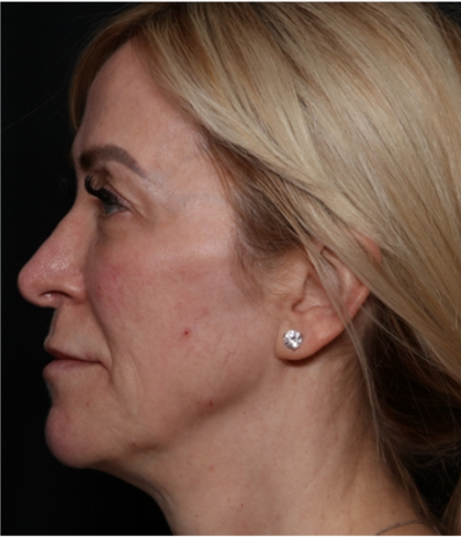 Injectable Fillers Before & After Patient #31232