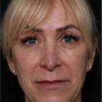 Injectable Fillers Before & After Patient #31232