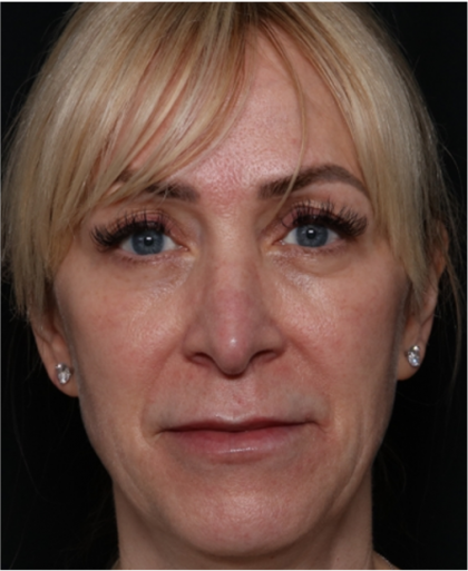 Injectable Fillers Before & After Patient #31232