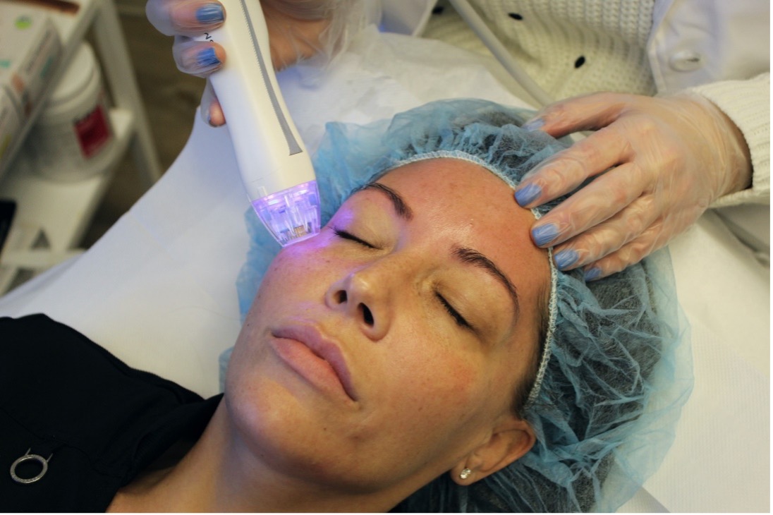 RF Microneedling