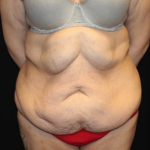 Body Lift Before & After Patient #31333