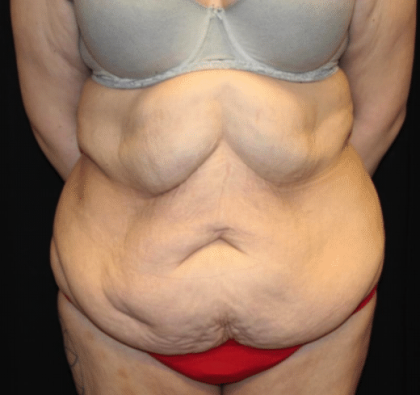 Body Lift Before & After Patient #31333