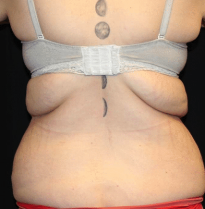 Body Lift Before & After Patient #31333