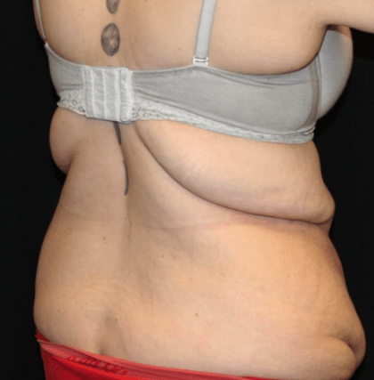 Body Lift Before & After Patient #31333