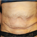 Tummy Tuck Before & After Patient #31310