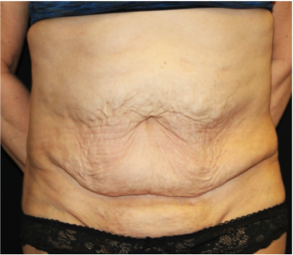 Tummy Tuck Before & After Patient #31310