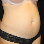 Tummy Tuck Before & After Patient #31299