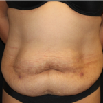 Tummy Tuck Before & After Patient #31321