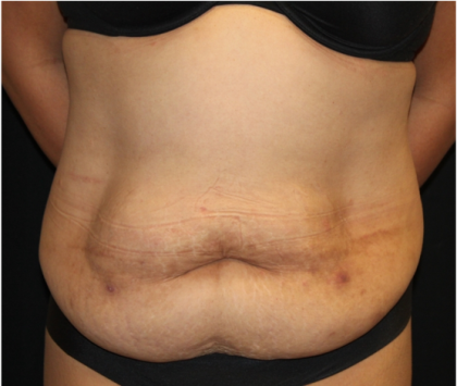 Tummy Tuck Before & After Patient #31321