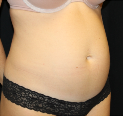 Tummy Tuck Before & After Patient #31299