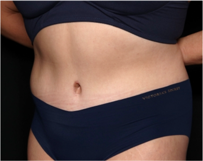 Tummy Tuck Before & After Patient #31321