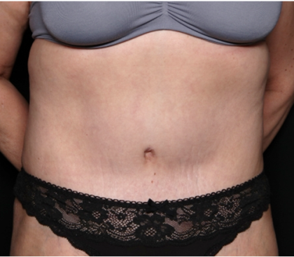 Tummy Tuck Before & After Patient #31310