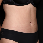 Tummy Tuck Before & After Patient #31299