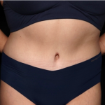 Tummy Tuck Before & After Patient #31321