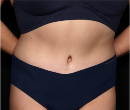 Tummy Tuck Before & After Patient #31321