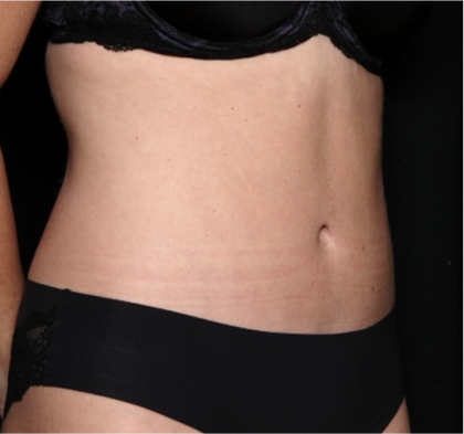 Tummy Tuck Before & After Patient #31299