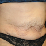 Tummy Tuck Before & After Patient #31310