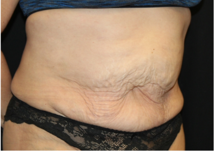 Tummy Tuck Before & After Patient #31310