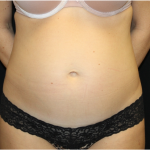 Tummy Tuck Before & After Patient #31299