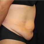Tummy Tuck Before & After Patient #31321