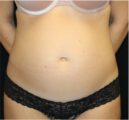 Tummy Tuck Before & After Patient #31299