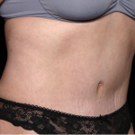 Tummy Tuck Before & After Patient #31310