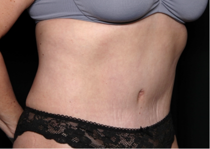 Tummy Tuck Before & After Patient #31310