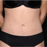 Tummy Tuck Before & After Patient #31299