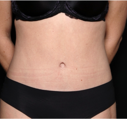 Tummy Tuck Before & After Patient #31299