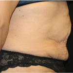 Tummy Tuck Before & After Patient #31310