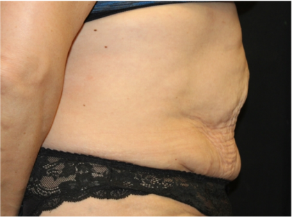 Tummy Tuck Before & After Patient #31310