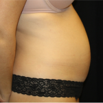 Tummy Tuck Before & After Patient #31299