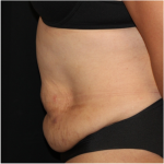 Tummy Tuck Before & After Patient #31321