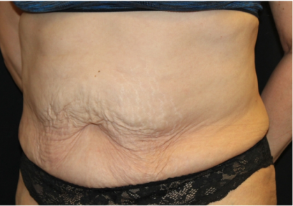 Tummy Tuck Before & After Patient #31310