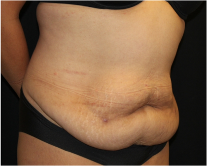 Tummy Tuck Before & After Patient #31321