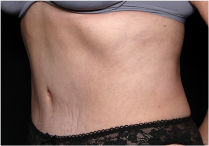 Tummy Tuck Before & After Patient #31310