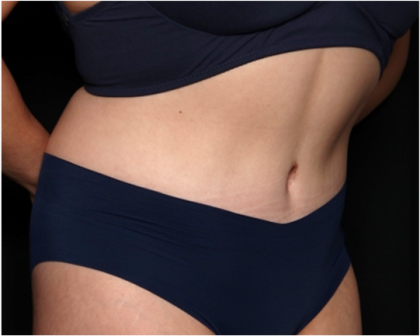 Tummy Tuck Before & After Patient #31321