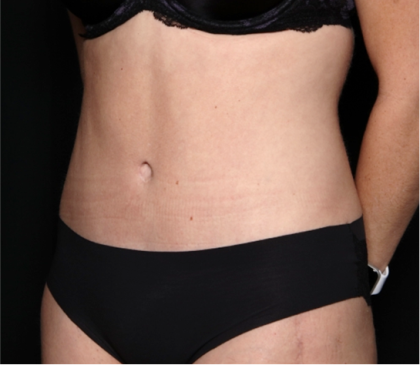 Tummy Tuck Before & After Patient #31299