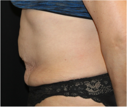 Tummy Tuck Before & After Patient #31310