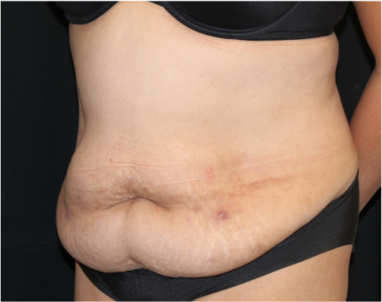 Tummy Tuck Before & After Patient #31321