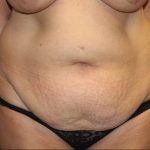 Tummy Tuck Before & After Patient #31363