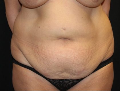 Tummy Tuck Before & After Patient #31363