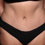 Tummy Tuck Before & After Patient #31363
