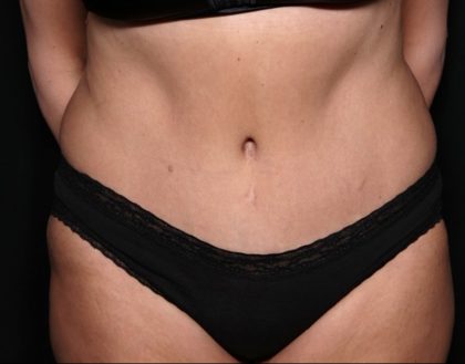 Tummy Tuck Before & After Patient #31363