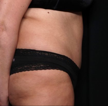 Tummy Tuck Before & After Patient #31363