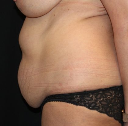 Tummy Tuck Before & After Patient #31363