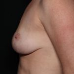 Breast Lift Before & After Patient #31352