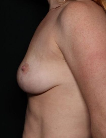 Breast Lift Before & After Patient #31352