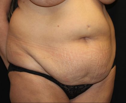 Tummy Tuck Before & After Patient #31363